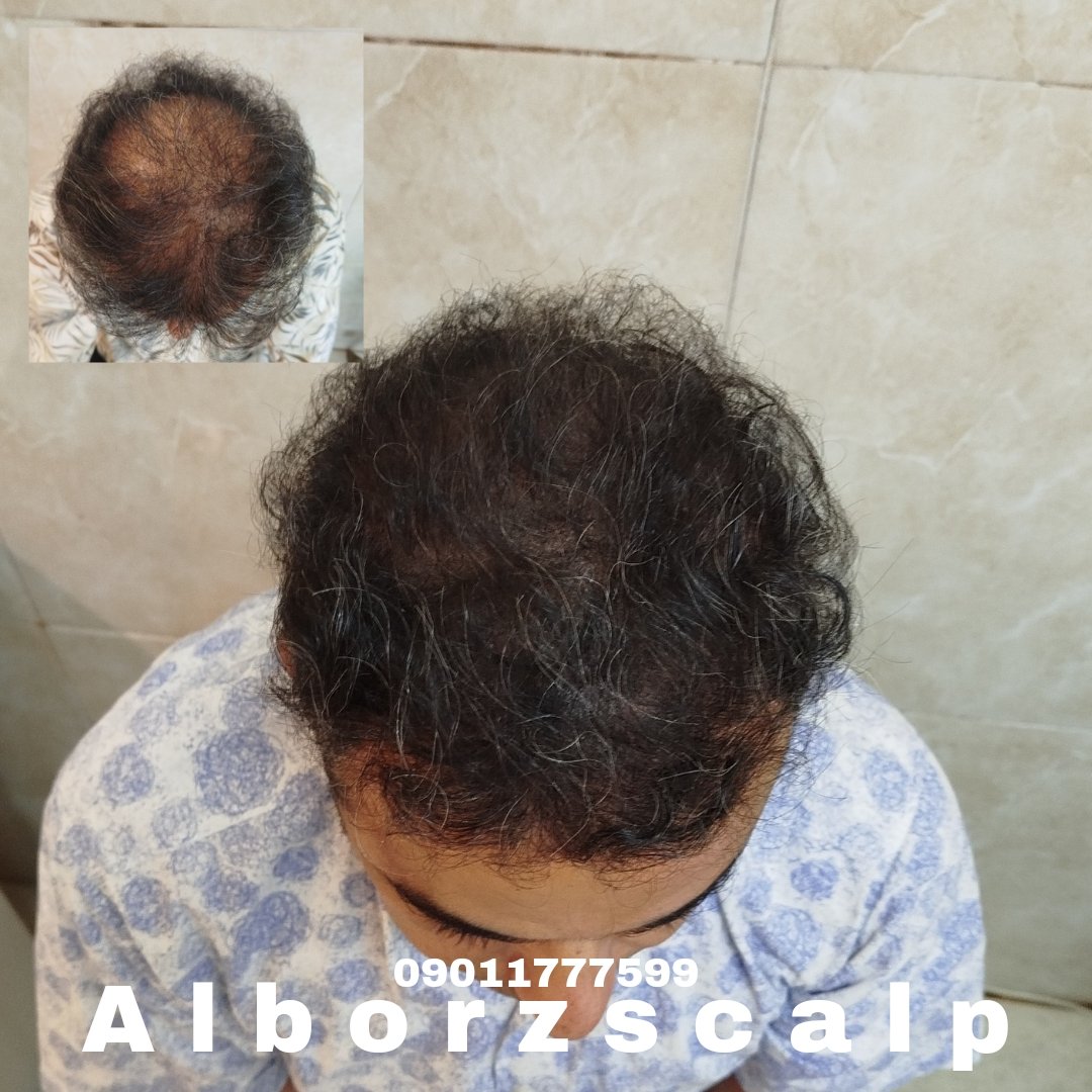 اسکالپ پوششی